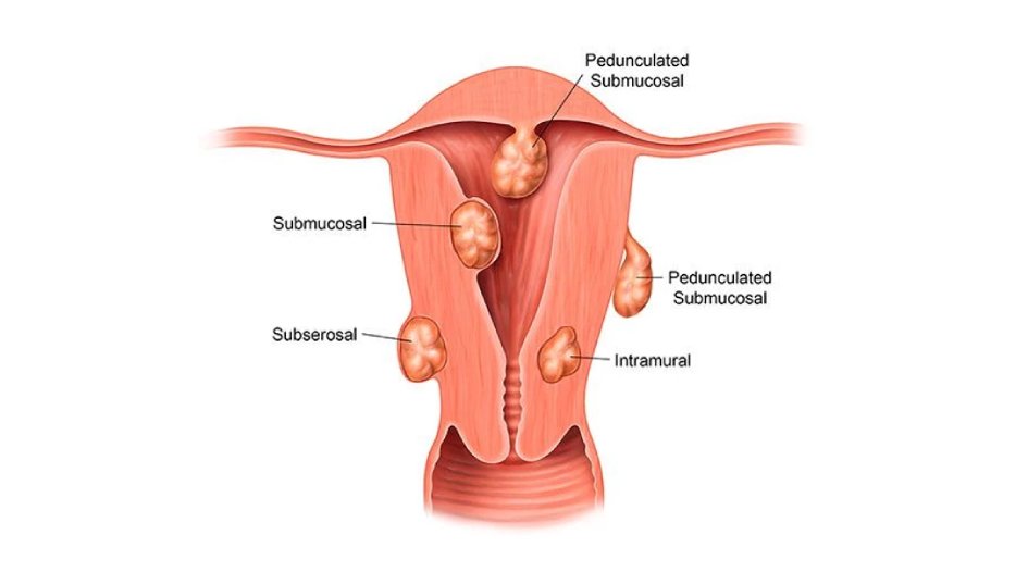 Fibroid Treatment Specialist